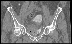 Bladder Perforation - CTisus CT Scan