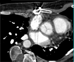 Pectus With Failed Repair - CTisus CT Scan