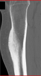 Osteoid Osteoma - CTisus CT Scan