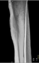 Osteoid Osteoma - CTisus CT Scan