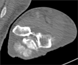 Gout - CTisus CT Scan