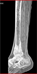 Myeloma - CTisus CT Scan