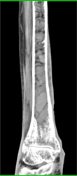 Myeloma - CTisus CT Scan