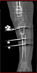 Tibial Fracture in Fixation Device - CTisus CT Scan