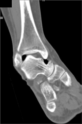 Fracture and Dislocation of the Ankle - CTisus CT Scan