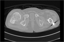 Congenital Hip Dysplasia With Open Reduction Internal Fixation (ORIF) - CTisus CT Scan