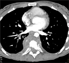 Tuberculosis (TB) Osteomyelitis T-spine - CTisus CT Scan