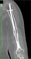 Myeloma - CTisus CT Scan