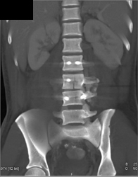 Fusion of Bone - CTisus CT Scan