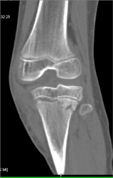 Tibial Fracture - CTisus CT Scan