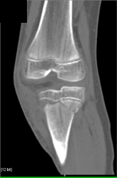 Tibial Fracture - CTisus CT Scan