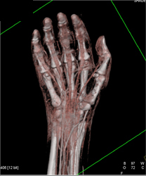 CTA of Hand With Bone Removal Algorithm - CTisus CT Scan