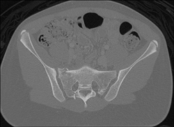 Sacral and Acetabular Fractures - CTisus CT Scan