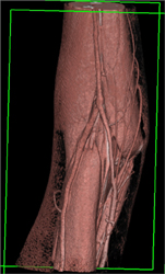 CTA Elbow With Vessel and Muscle Definition - CTisus CT Scan