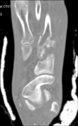 Multiple Fractures - CTisus CT Scan