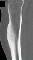 Osteoid Osteoma - CTisus CT Scan