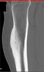 Osteoid Osteoma - CTisus CT Scan