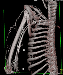 CTA Axillary Region - CTisus CT Scan