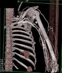 3D CTA of Axilla and Breast With Various Renderings - CTisus CT Scan