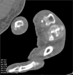 Gout - CTisus CT Scan