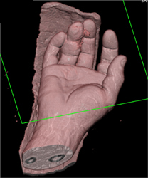 Injury to the Digit With Skin Ulcerations - CTisus CT Scan