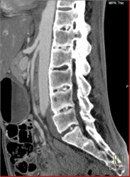 Calcified Discs - CTisus CT Scan