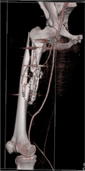 Femur Fracture Due to GSW Without Vascular Injury - CTisus CT Scan