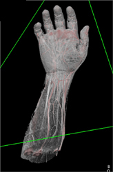 CTA of Hand With Multiple Renderings - CTisus CT Scan