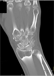 Scaphoid Fracture - CTisus CT Scan