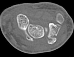 Scaphoid Fracture - CTisus CT Scan