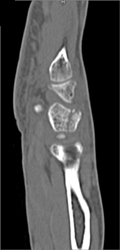 Scaphoid Fracture - CTisus CT Scan