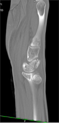 Scaphoid Fracture - CTisus CT Scan