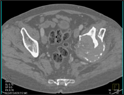 Myeloma With Fracture - CTisus CT Scan