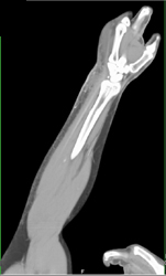 Cellulitis in Multiple Renderings - CTisus CT Scan