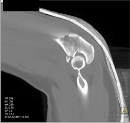 Ulnar Fracture and Radius Fracture - CTisus CT Scan