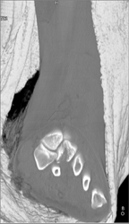 Fracture and Dislocation of Tarsals and Metatarsals - CTisus CT Scan