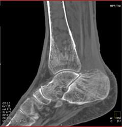 Stasis Induced Ulcer and Osteoporosis - CTisus CT Scan