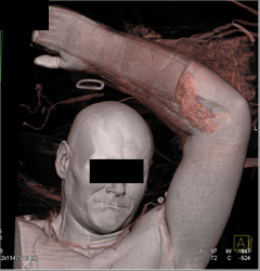 Injury to Forearm - CTisus CT Scan