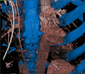 Sternum Removal for Cardiac Ct - CTisus CT Scan