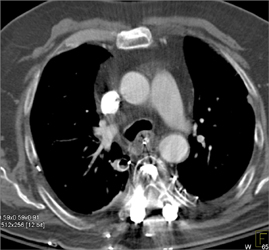 Complication of Spiral Surgery-is Pe - CTisus CT Scan