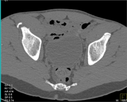 Acetabular Fracture With Avulsion - CTisus CT Scan