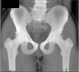 Iliac Fracture on Right Off Anterior Spine - CTisus CT Scan