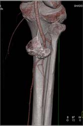 Exostosis Pushes Trifurcation Vessels - CTisus CT Scan