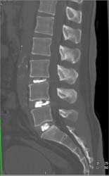 Injected Disc Spaces - CTisus CT Scan