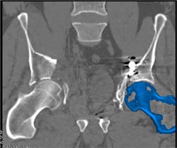 Bone Removal for New Fracture in Patient With Prior Hip Fracture and Repair on Contralateral Side - CTisus CT Scan