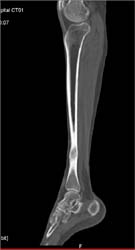 Osteomyelitis - CTisus CT Scan