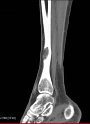 Osteomyelitis - CTisus CT Scan