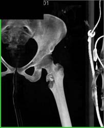 GSW With Fracture - CTisus CT Scan