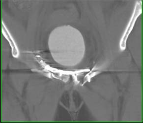 Repair of Pelvis Fractures - CTisus CT Scan