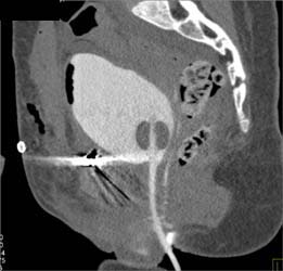 No Bladder Injury - CTisus CT Scan